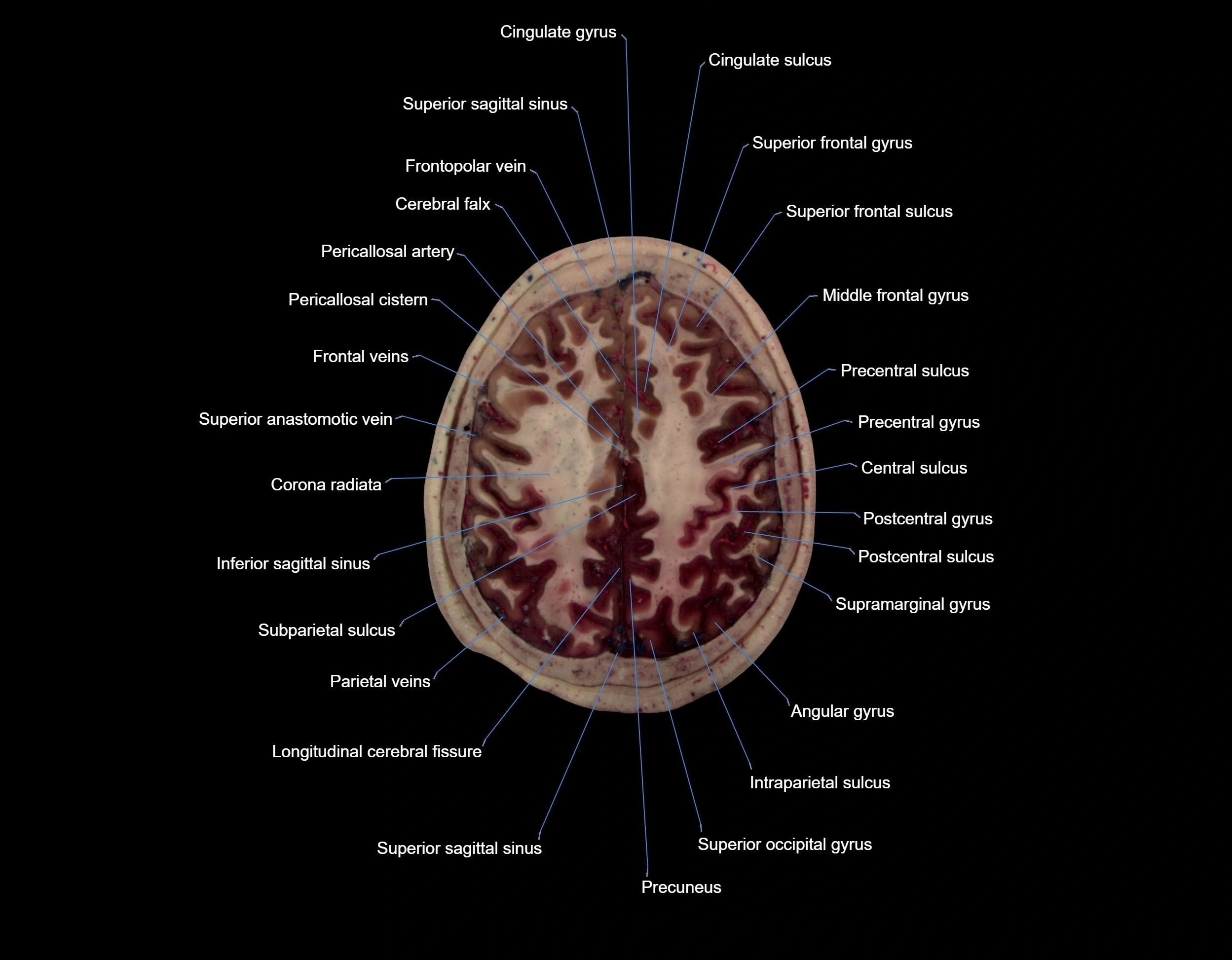 MRI Brain axial cross sectional radiology anatomy 3T image  -img-000060.webp